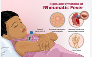 Everything you need to know about the rheumatic fever of childhood