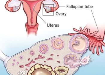 How Is a Cyst Formed in the Ovary? (Complete Guide)