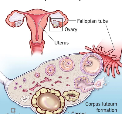 How Is a Cyst Formed in the Ovary? (Complete Guide)