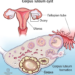 How Is a Cyst Formed in the Ovary? (Complete Guide)