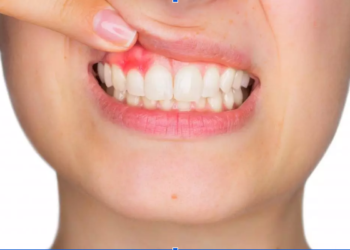 What Causes an Infection After a Root Canal?