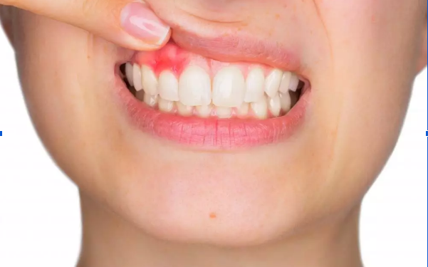 What Causes an Infection After a Root Canal?